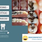 consulta y resina dental